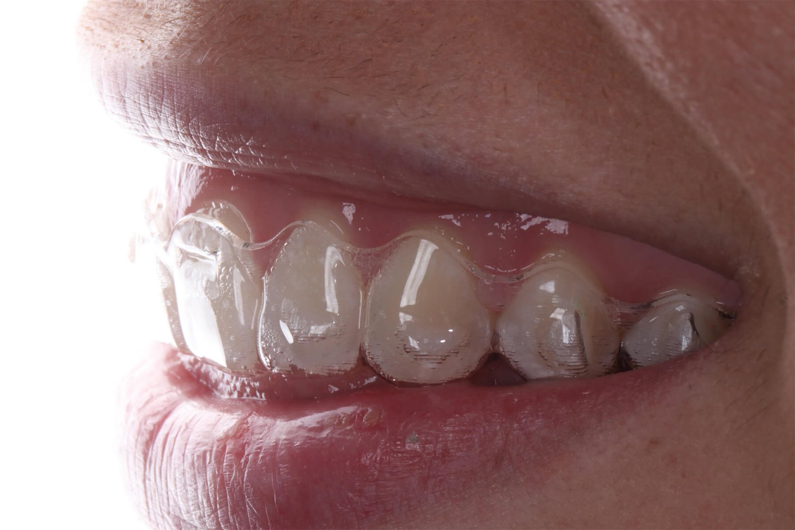 Como cuidar dos seus alinhadores Invisalign, Donegá Odontologia